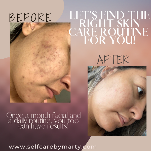 SCBM Acne Battle Facial - Self Care by~Marty